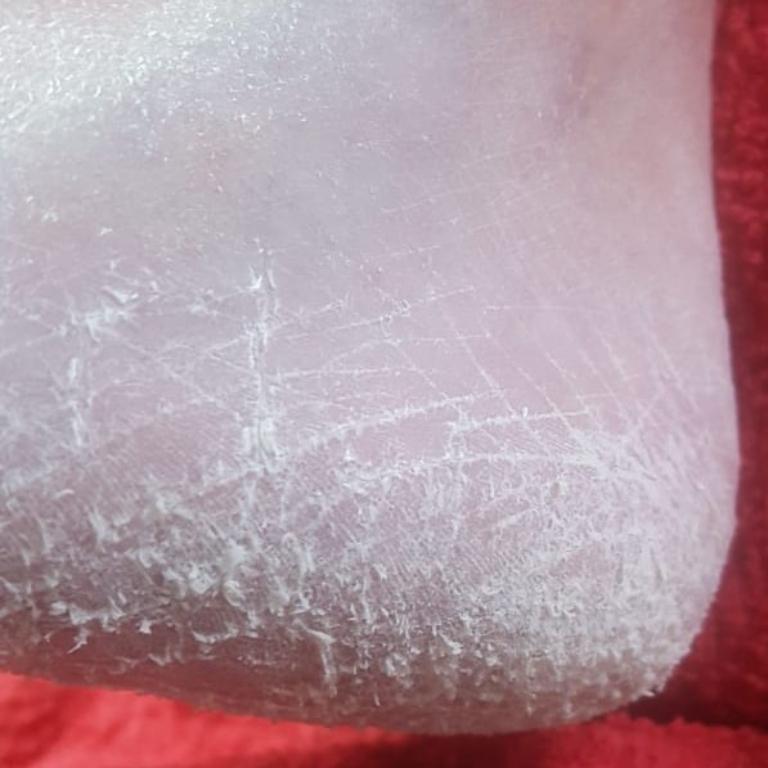 Fusspilze, Hühneraugen, Warzen, Nagelpilz Fusspflege in Emmen - Bild 4